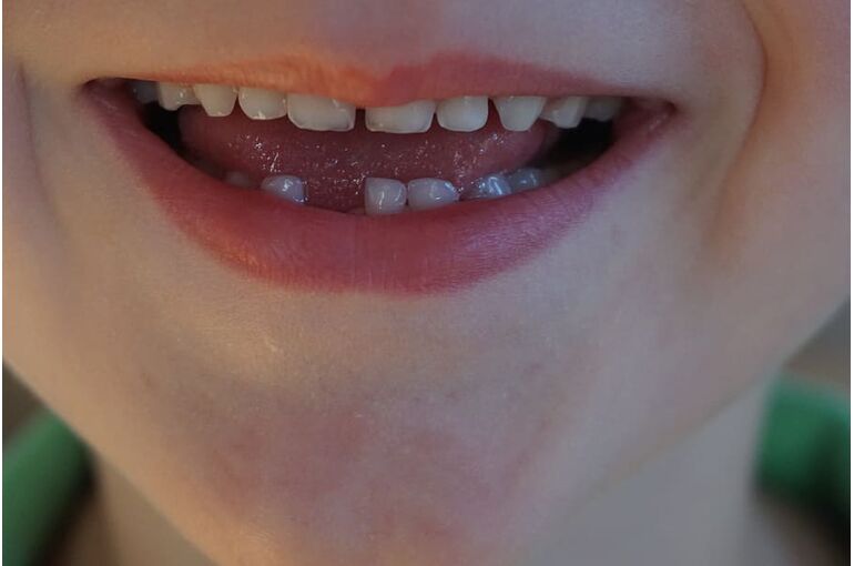 gap-milk-tooth-child-laugh