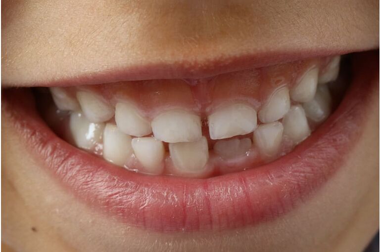 teeth-child-smile-child-dental