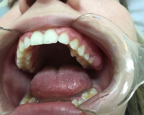 dentist-mouth-open-mouth-tool