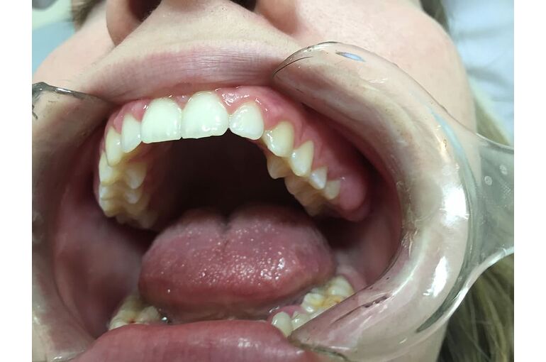 dentist-mouth-open-mouth-tool
