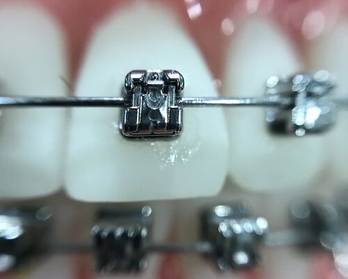zoom-orthodontics-iphone