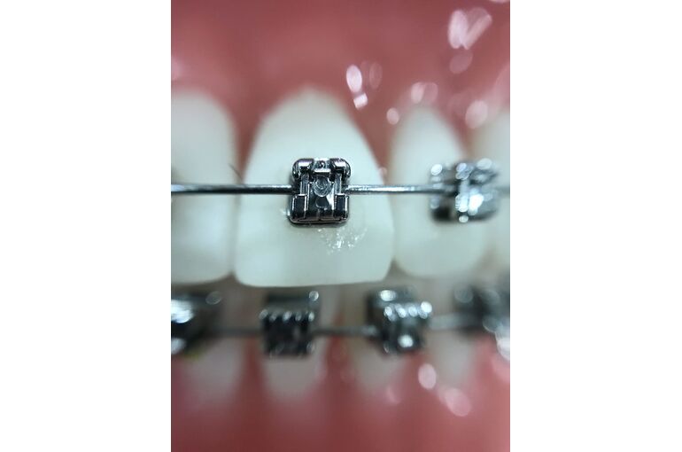 zoom-orthodontics-iphone